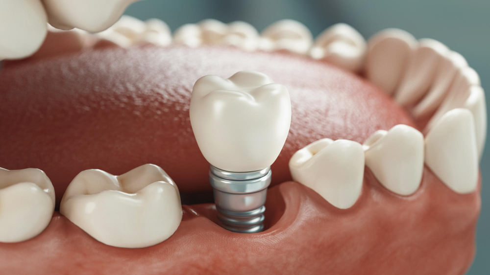 Dental Implants image